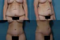 Tummy Tuck Case #285 Combined Image