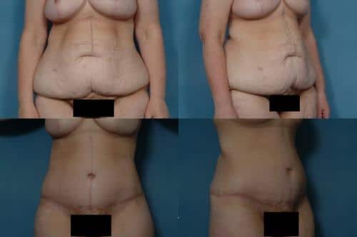 Tummy Tuck Case #285 Combined Image