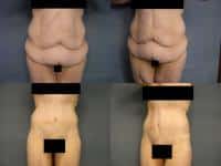 Tummy Tuck Case #288 Combined Image