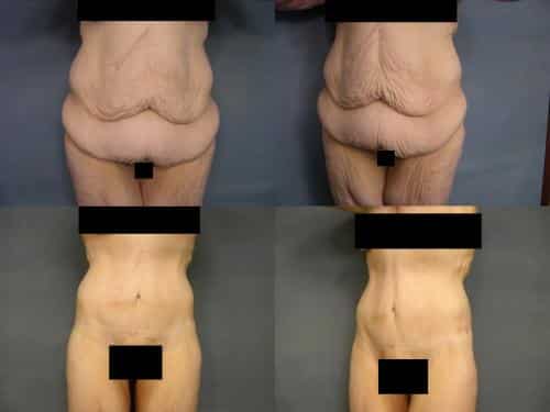 Tummy Tuck Case #288 Combined Image