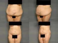 Tummy Tuck Case #289 Combined Image