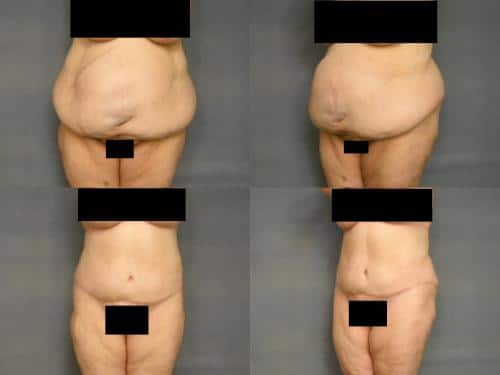 Tummy Tuck Case #289 Combined Image
