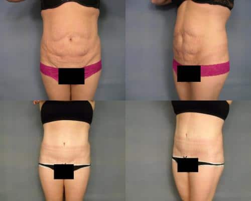 Tummy Tuck Case #294 Combined Image