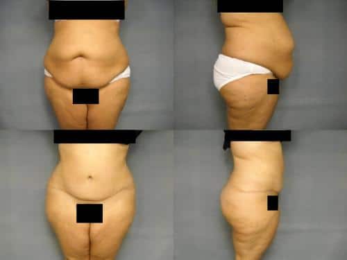 Tummy Tuck Case #295 Combined Image