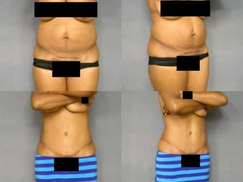 Tummy Tuck Case #296 Combined Image