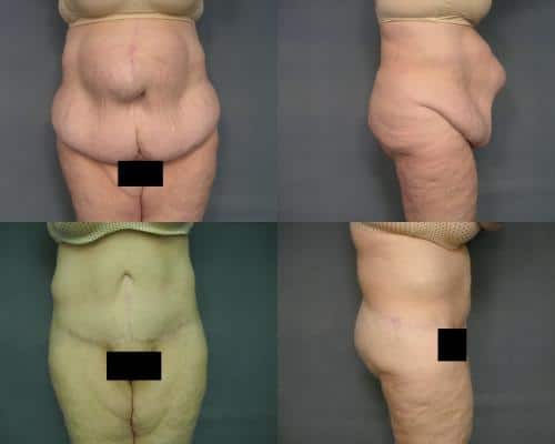 Tummy Tuck Case #300 Combined Image