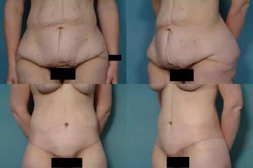 Tummy Tuck Case #301 Combined Image