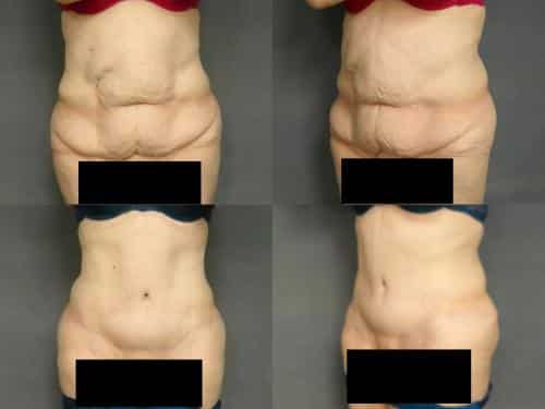 Tummy Tuck Case #307 Combined Image