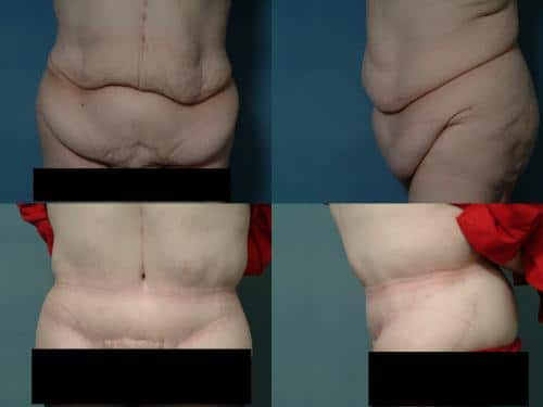 Tummy Tuck Case #331 Combined Image