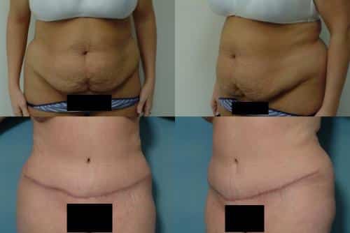 Tummy Tuck Case #471 Combined Image