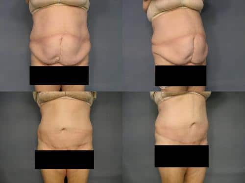 Tummy Tuck Case #521 Combined Image