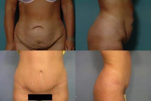 Tummy Tuck Case #561 Combined Image