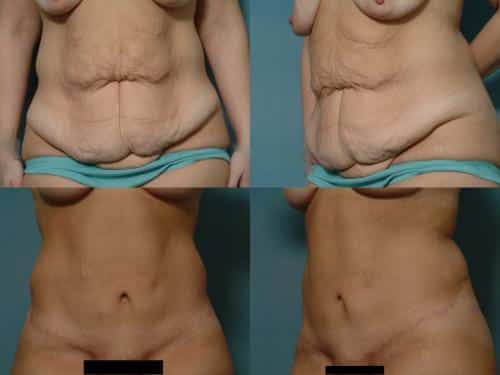Tummy Tuck Case #641 Combined Image