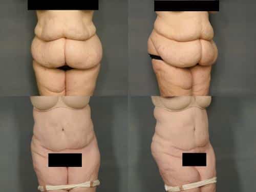 Tummy Tuck Case #651 Combined Image