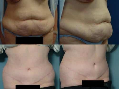 Tummy Tuck Case #691 Combined Image