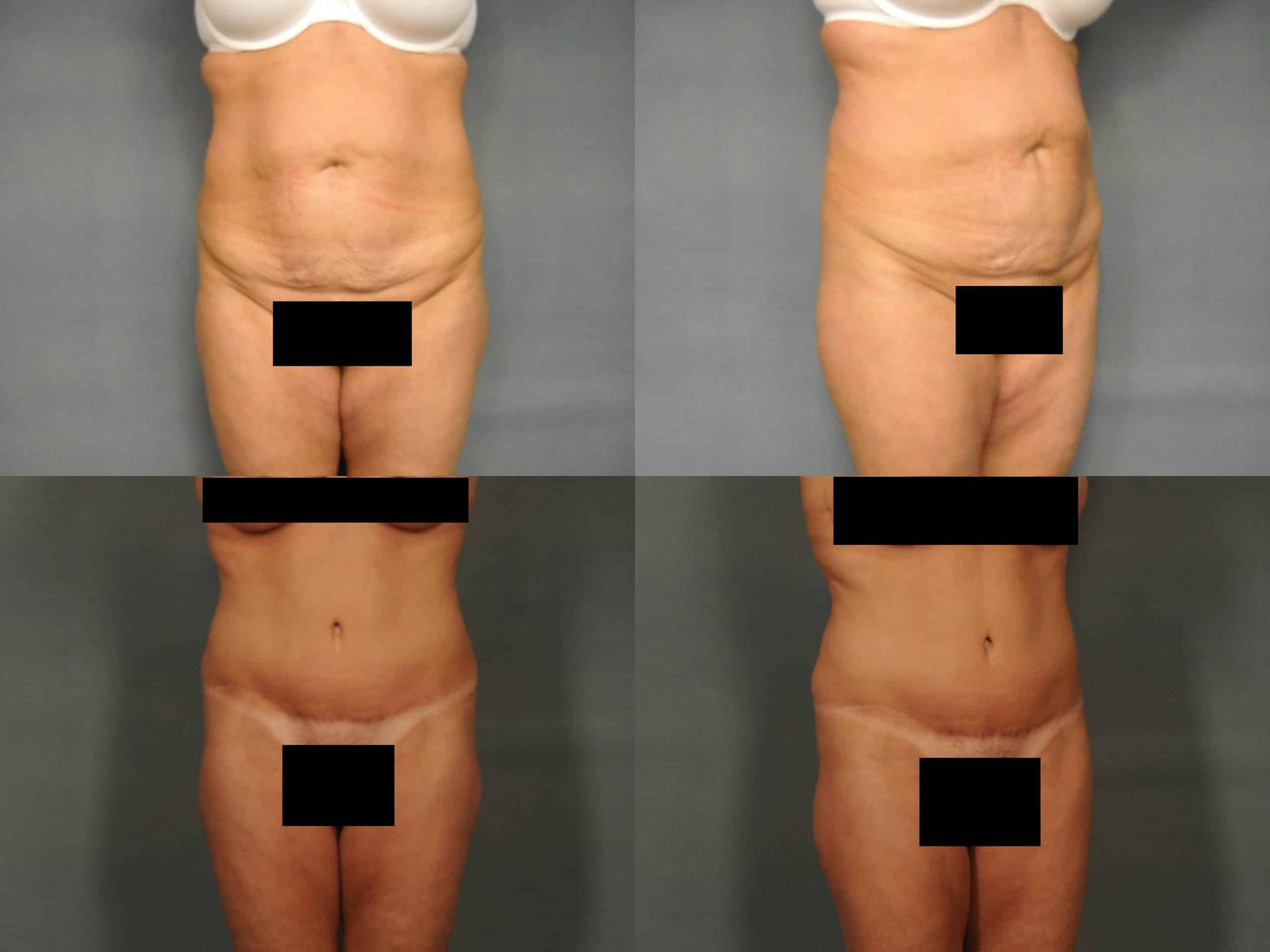 Tummy Tuck Case# 764 Combined Image