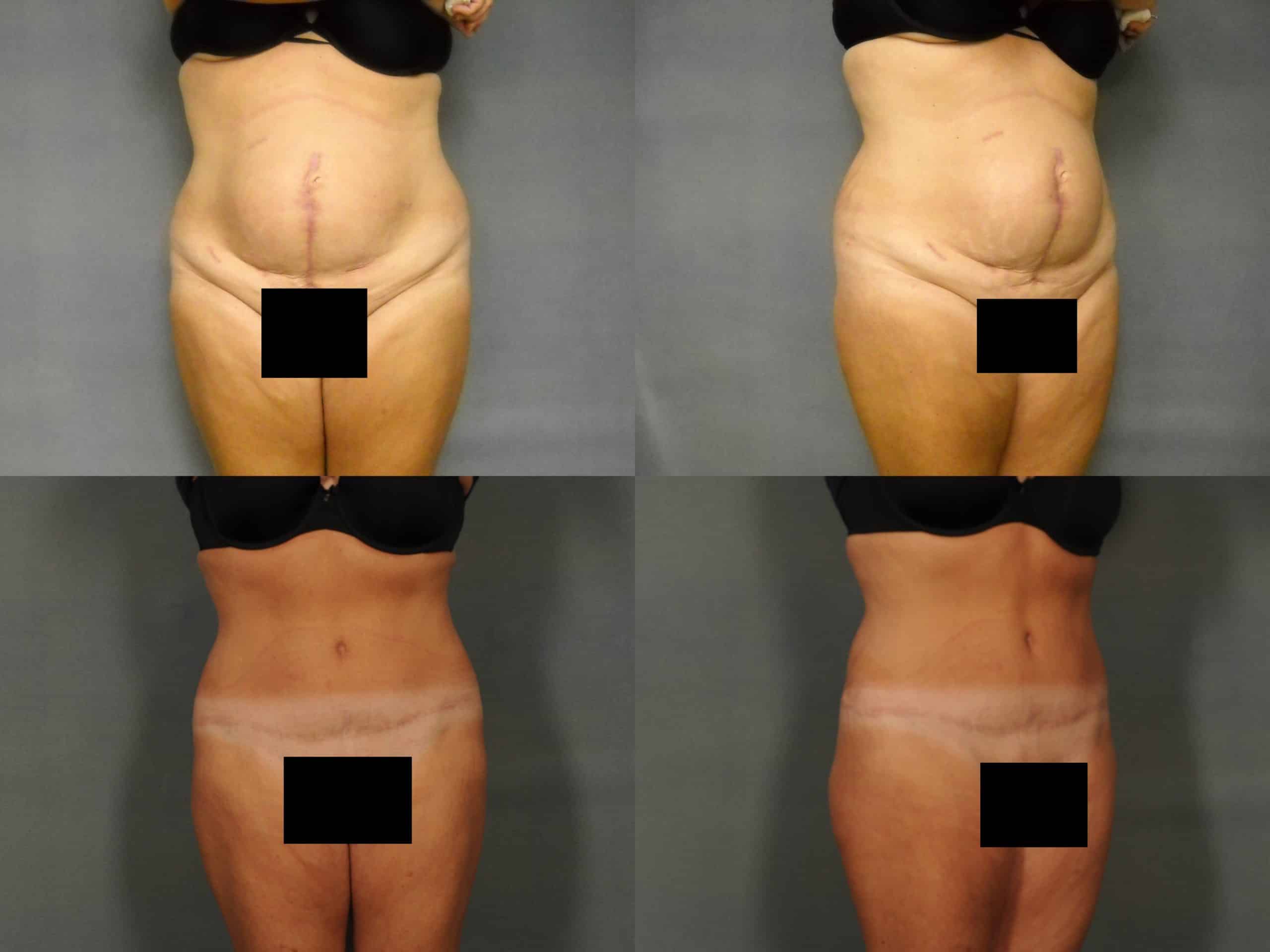 Tummy Tuck Case# 767 Combined Image