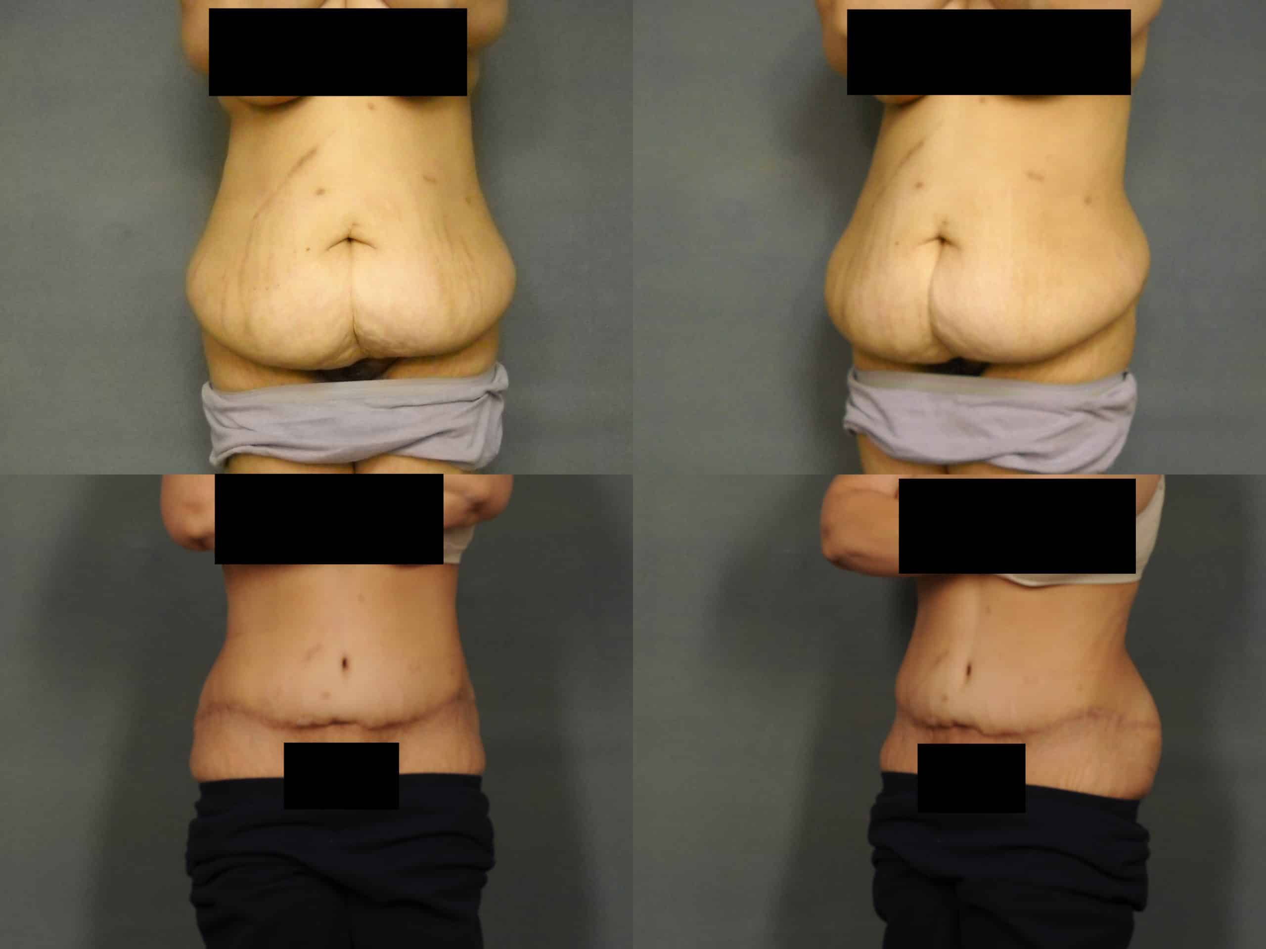 Tummy Tuck Case# 768 Combined Image