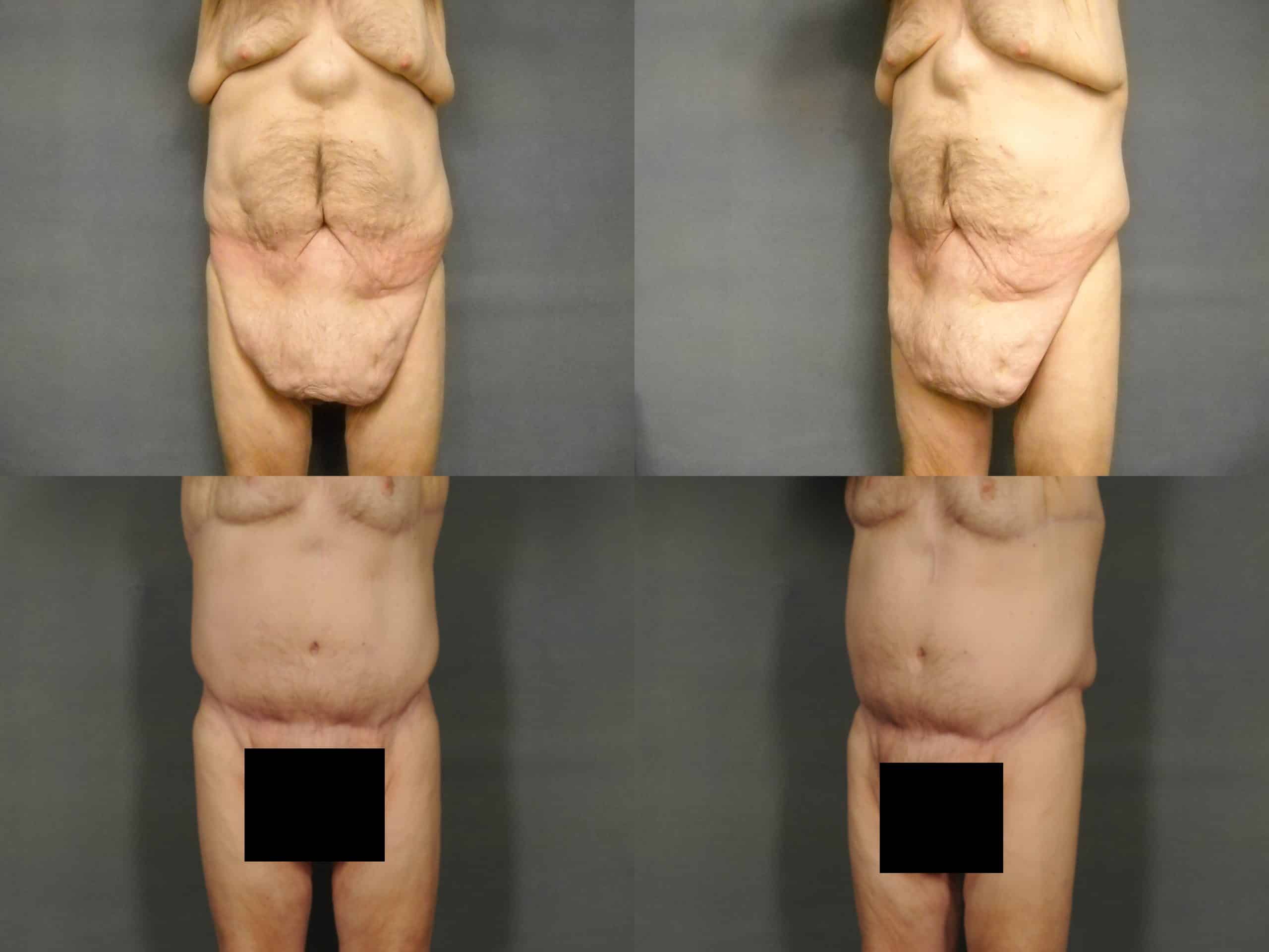 Tummy Tuck Case# 769 Combined Image
