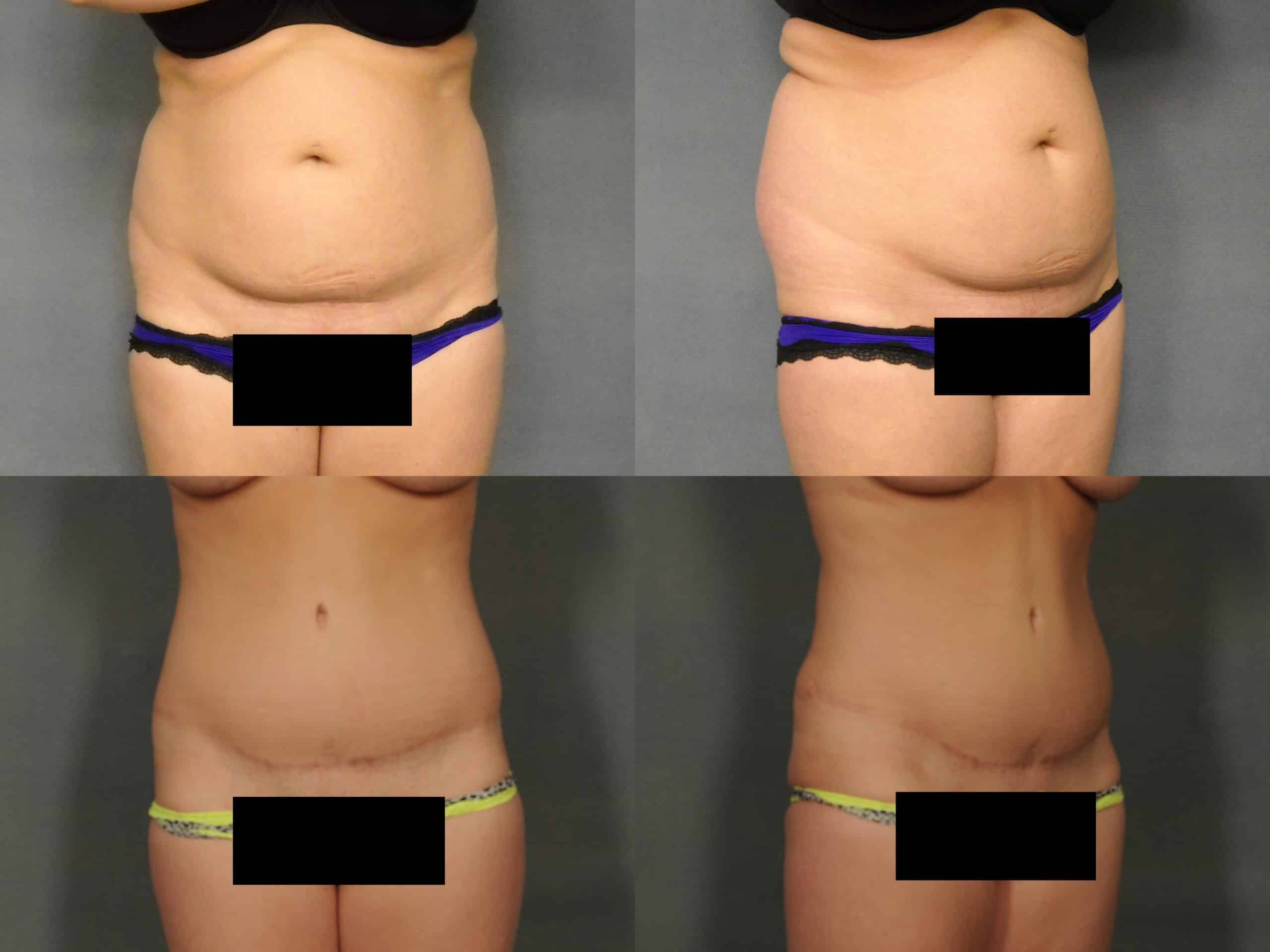 Tummy Tuck Case# 771 Combined Image