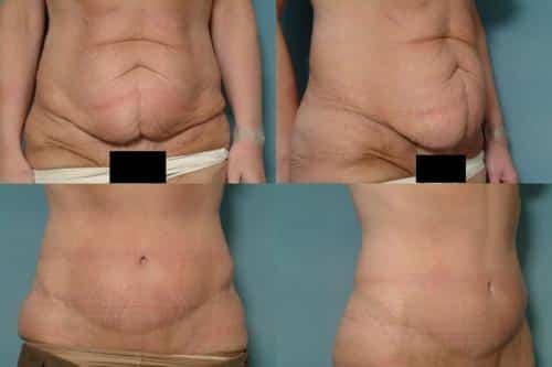 Tummy Tuck Case #771 Combined Image