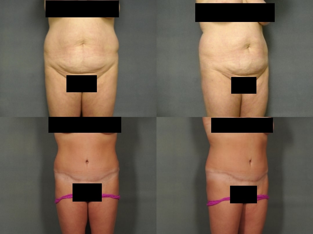 Tummy Tuck Case# 774 Combined Image