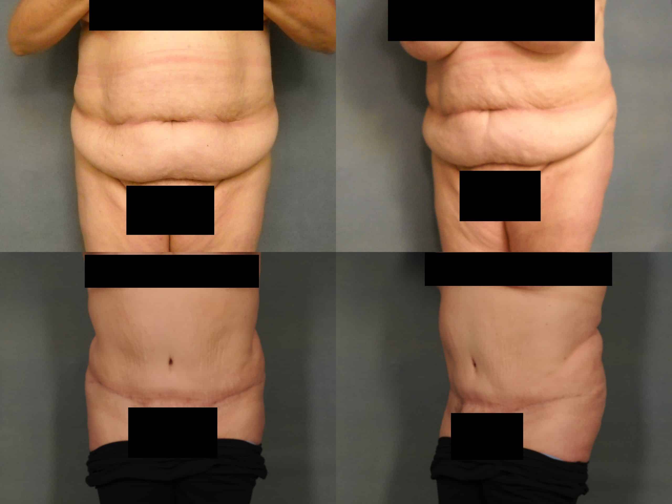 Tummy Tuck Case# 777 Combined Image