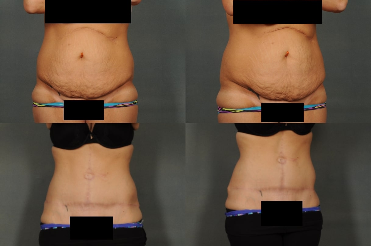 Tummy Tuck Case# 778 Combined Image