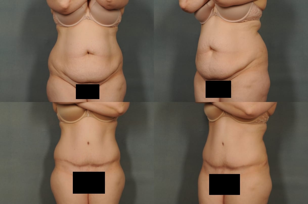 Tummy Tuck Case# 779 Combined Image