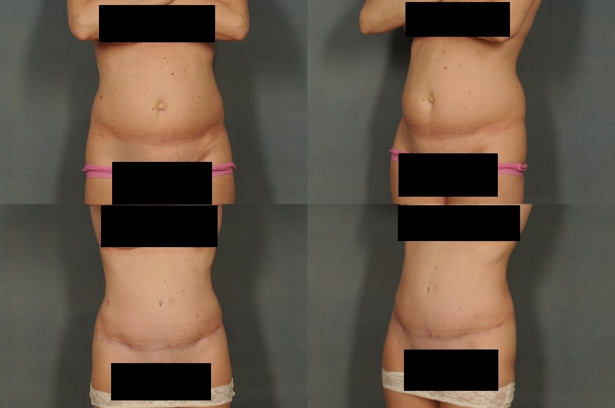 Tummy Tuck Case# 780 Combined Image