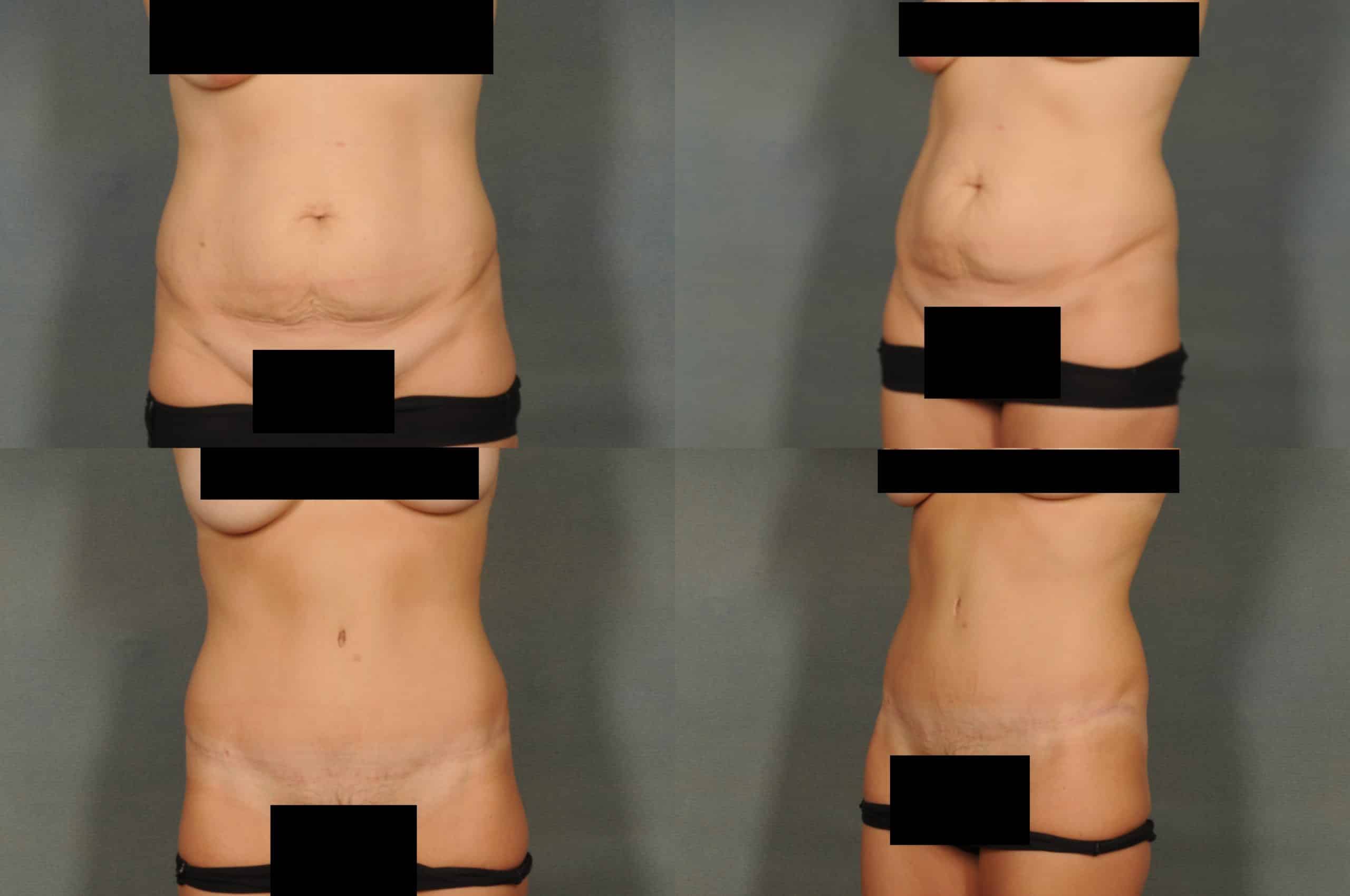 Tummy Tuck Case# 782 Combined Image
