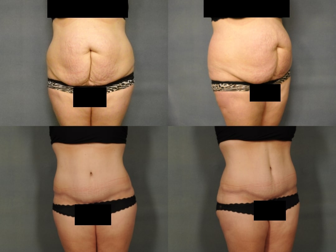 Tummy Tuck Case# 784 Combined Image