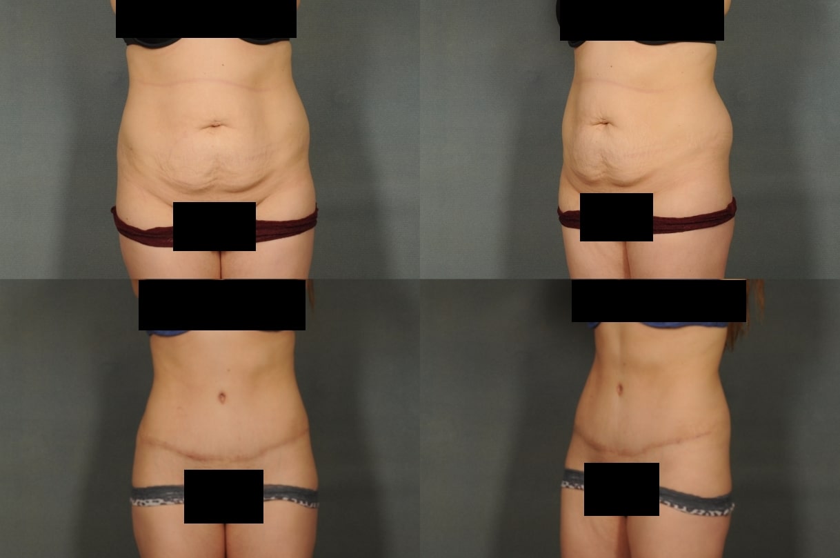 Tummy Tuck Case# 789 Combined Image