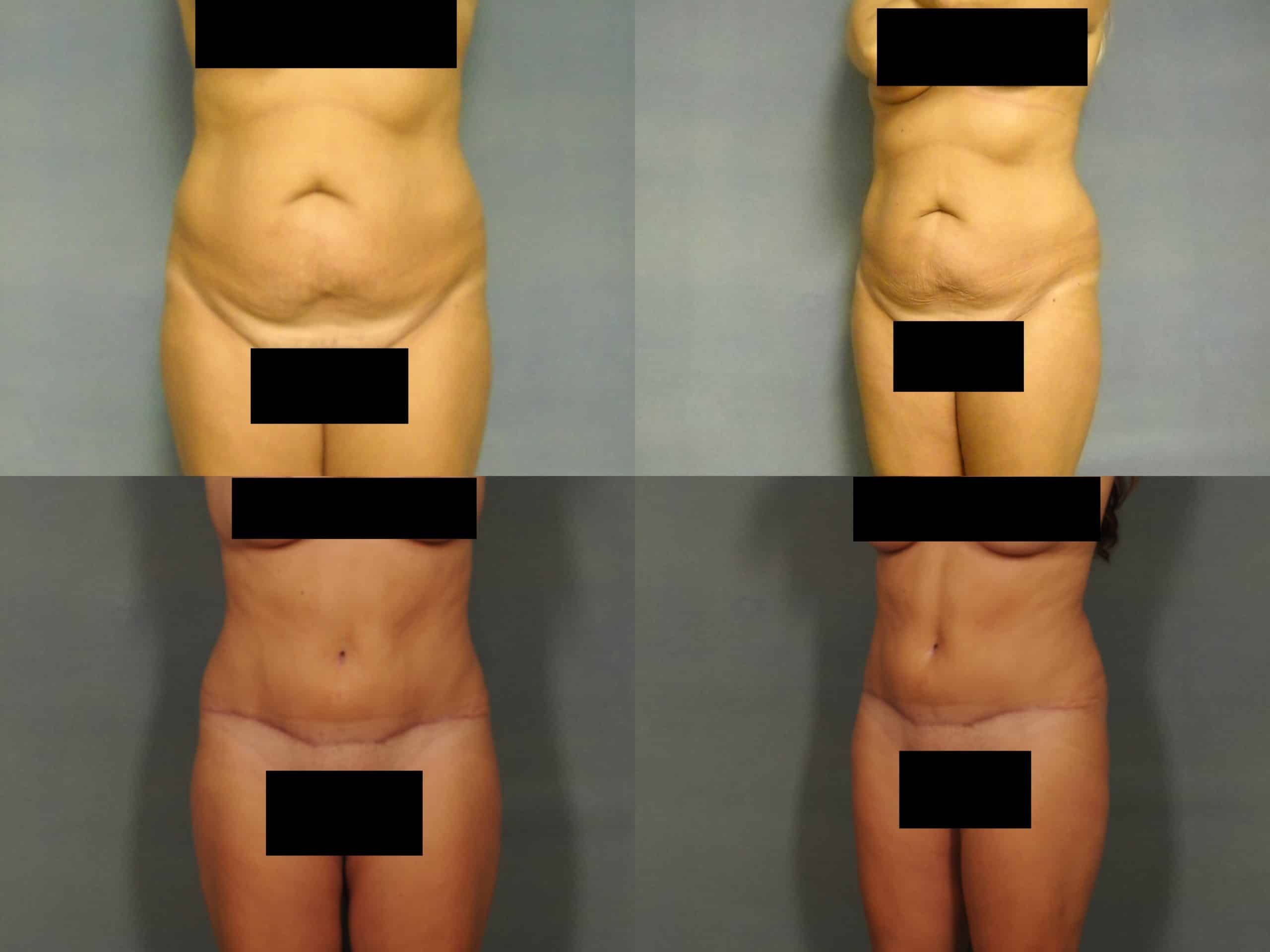 Tummy Tuck Case# 790 Combined Image