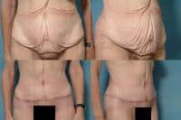 Tummy Tuck Case #791 Combined Image