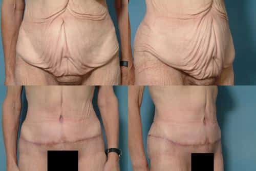 Tummy Tuck Case #791 Combined Image