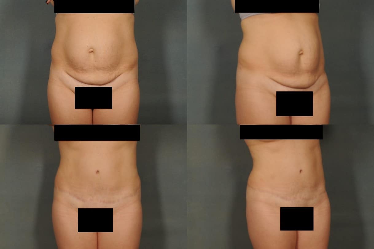 Tummy Tuck Case# 797 Combined Image