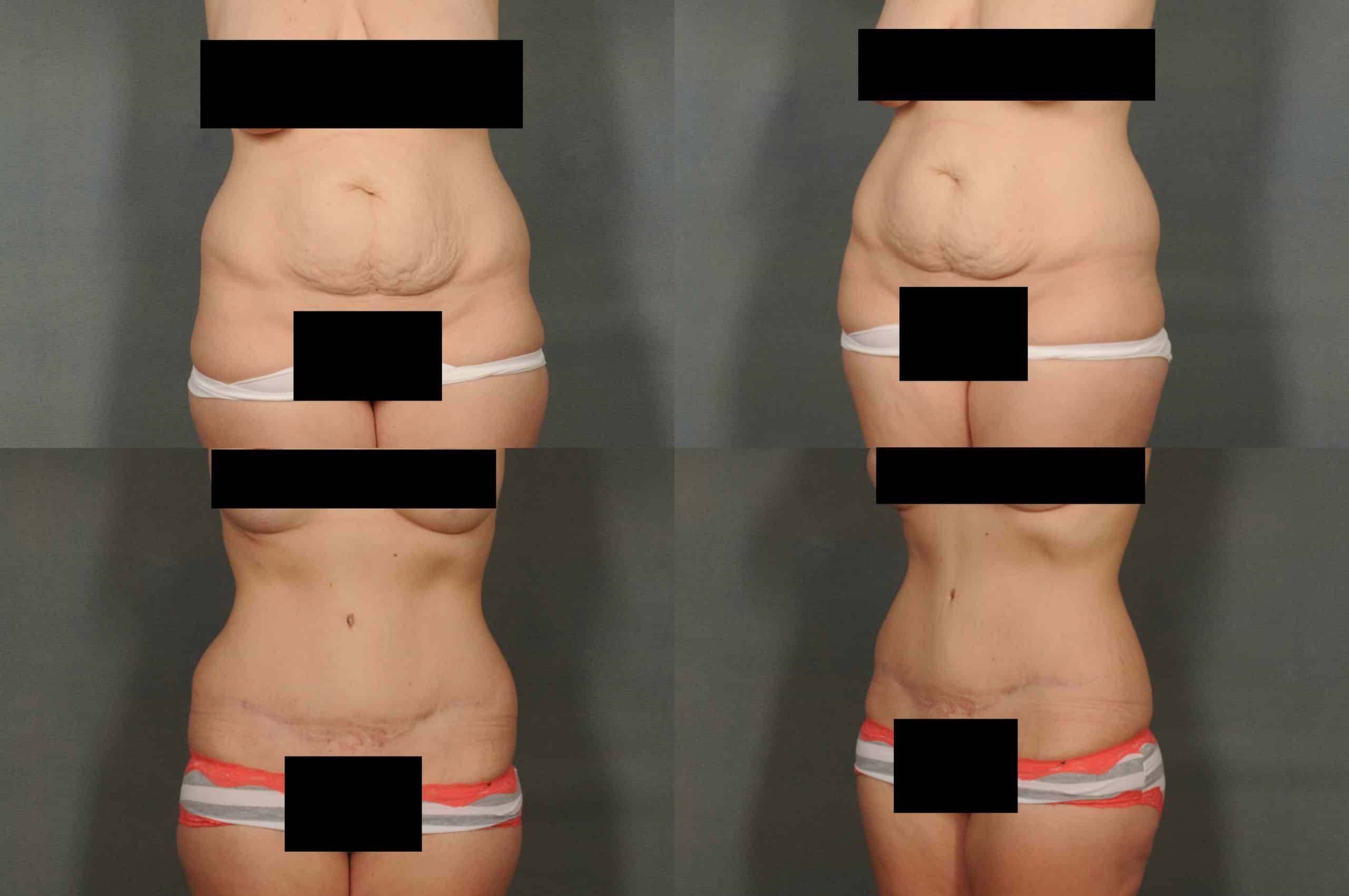 Tummy Tuck Case# 798 Combined Image