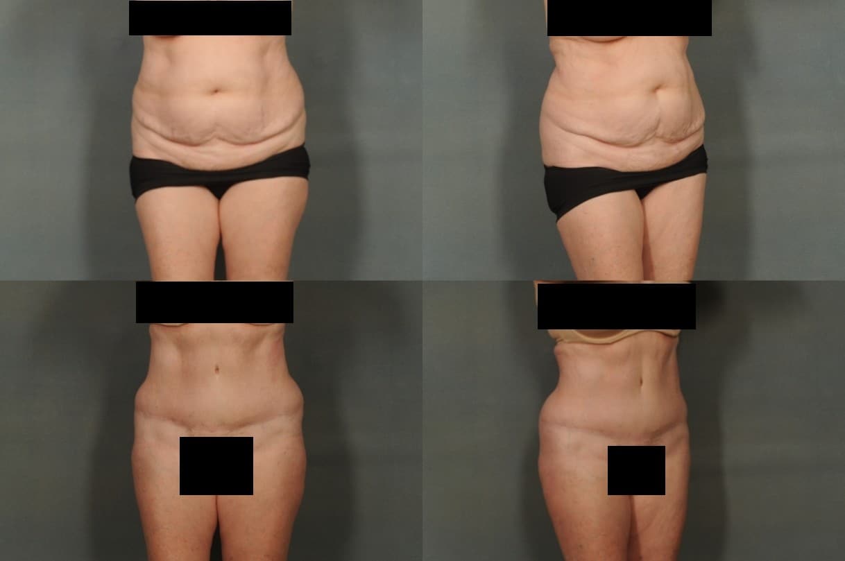 Tummy Tuck Case# 802 Combined Image
