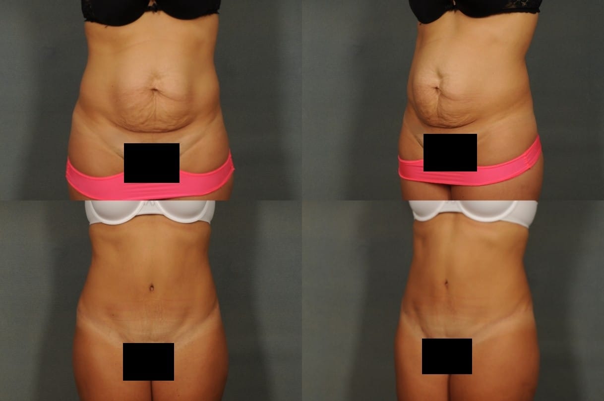 Tummy Tuck Case# 804 Combined Image