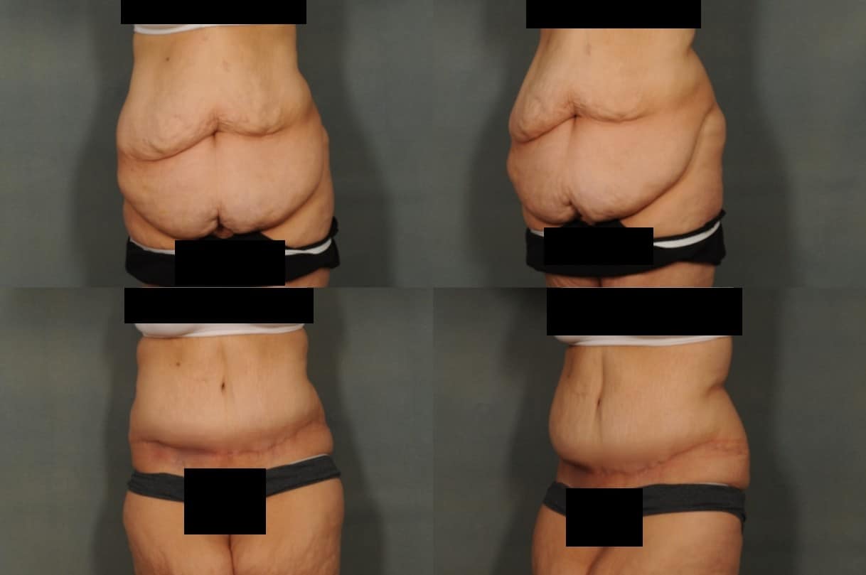 Tummy Tuck Case# 806 Combined Image