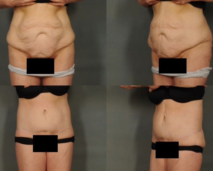 Tummy Tuck Case# 815 Combined Image