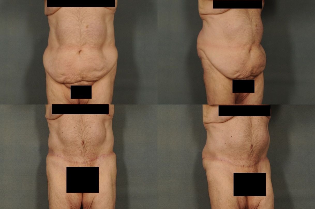 Tummy Tuck Case# 818 Combined Image