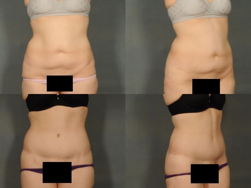 Tummy Tuck Case# 819 Combined Image
