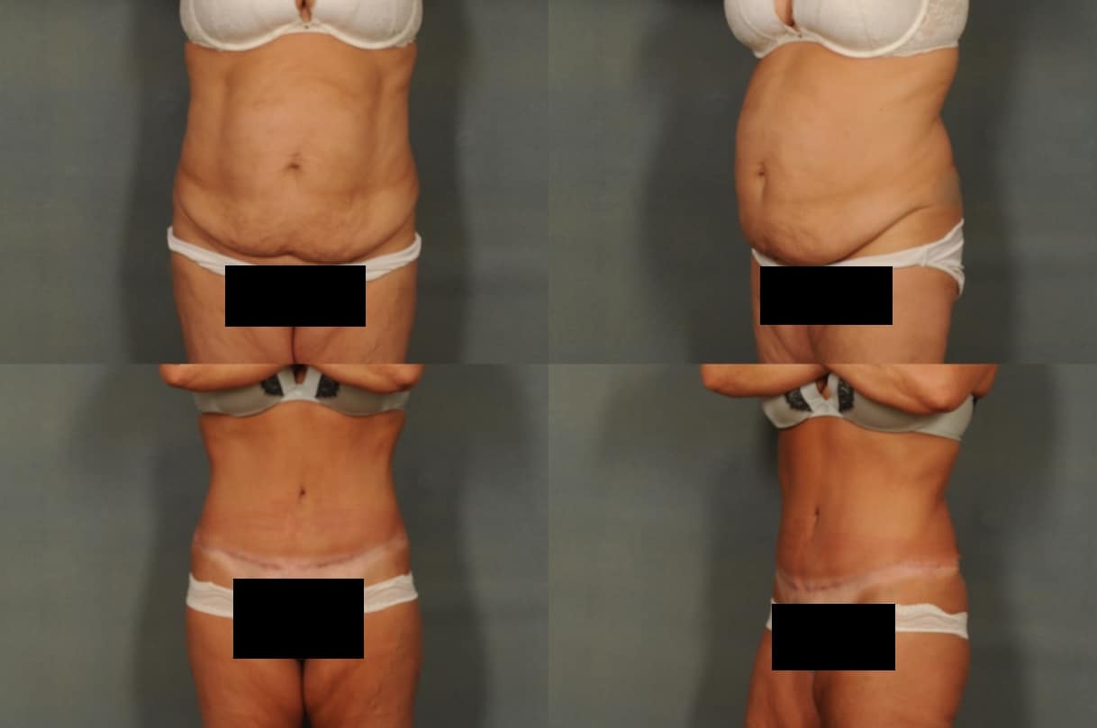 Tummy Tuck Case# 824 Combined Image