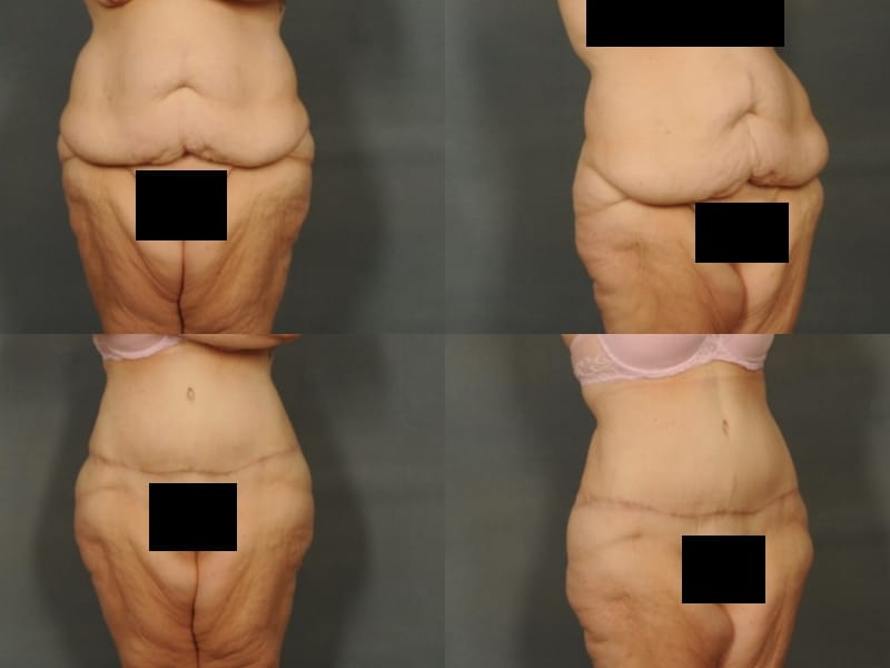 Tummy Tuck Case# 825 Combined Image