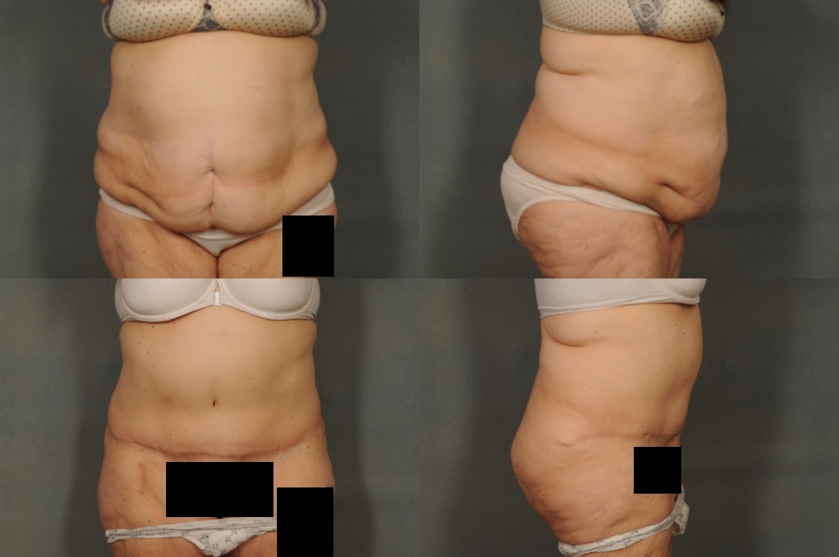 Tummy Tuck Case# 826 Combined Image