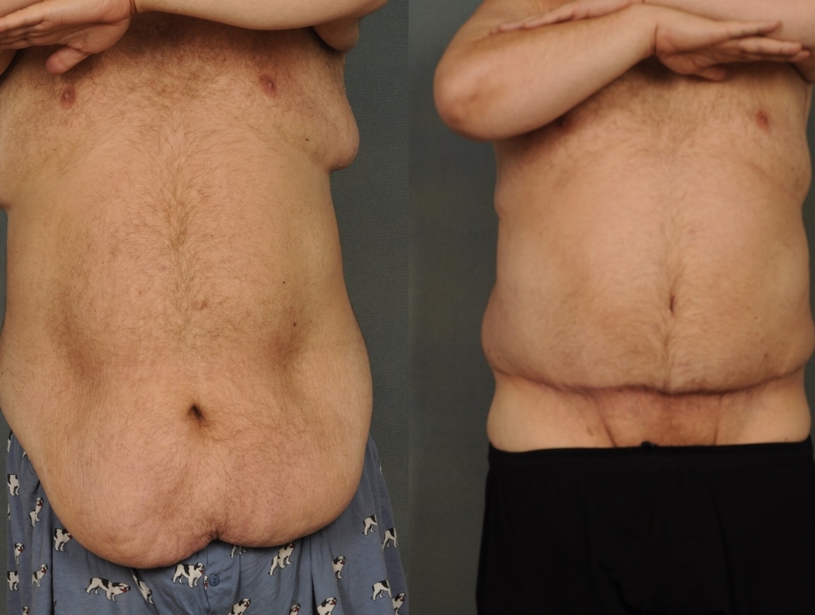 Tummy Tuck Case# 831 Combined Image