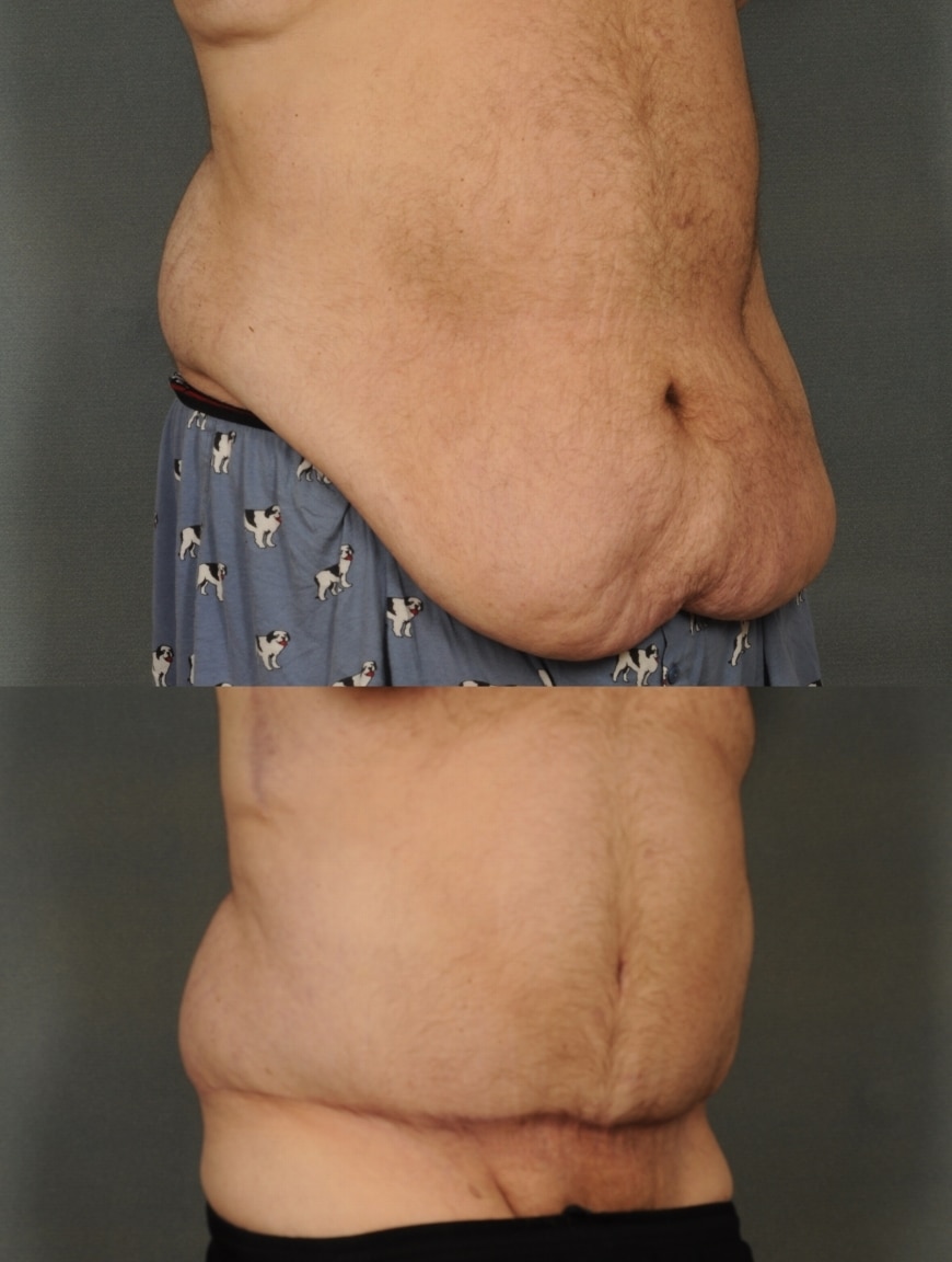 Tummy Tuck Case# 832 Combined Image