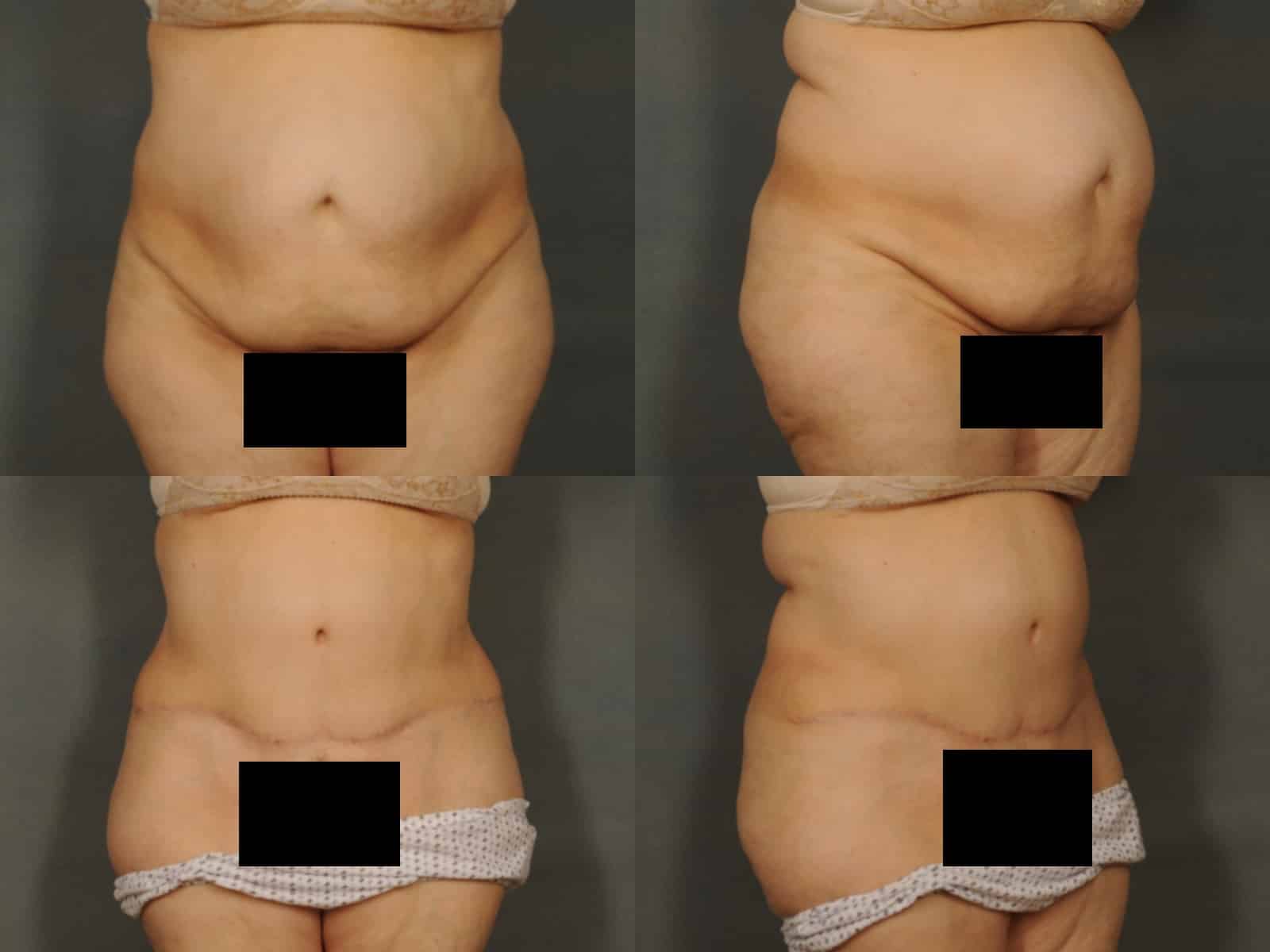 Tummy Tuck Case# 838 Combined Image